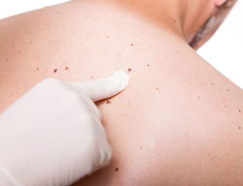 Mole removal.  How to know if your mole is harmless or life-threatening.