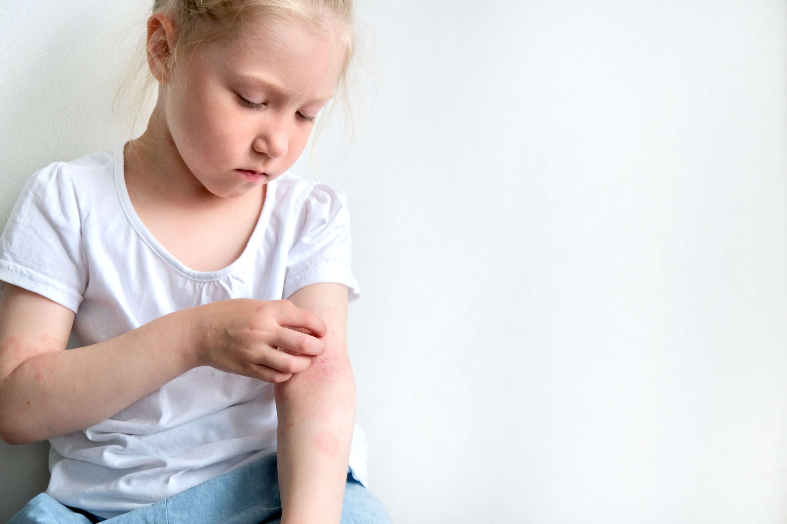 picture of child scratching atopic eczema on her arm