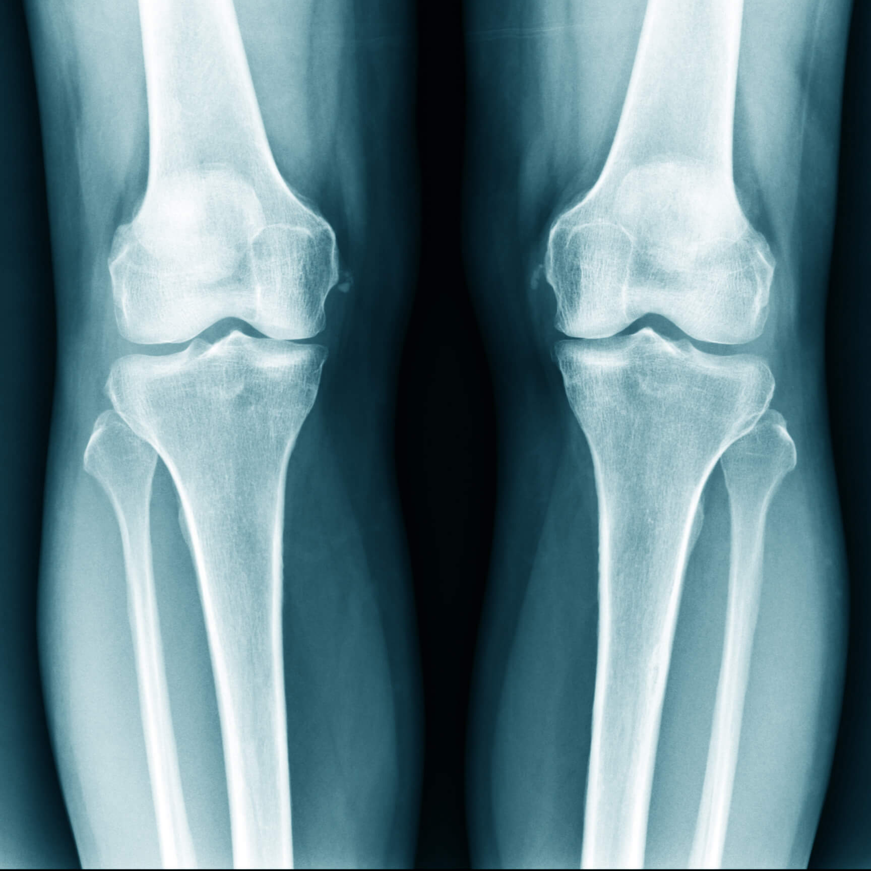 knee arthritis xray