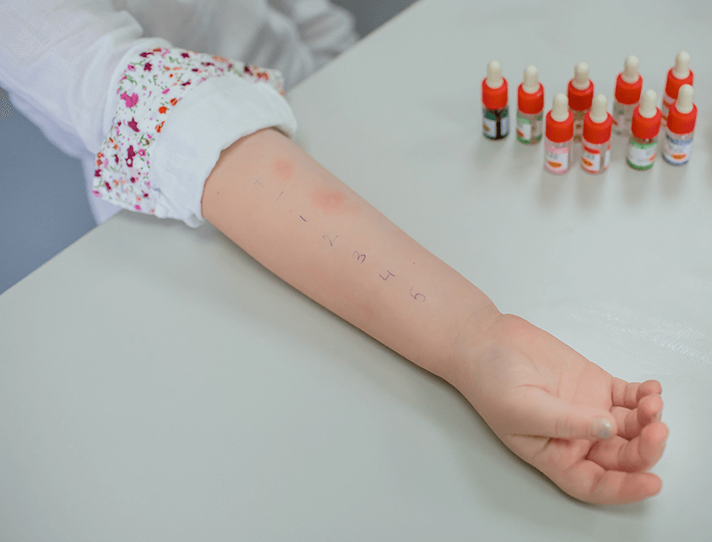Skin prick allergy testing postive results child's arm with positive skin prick allergy test response