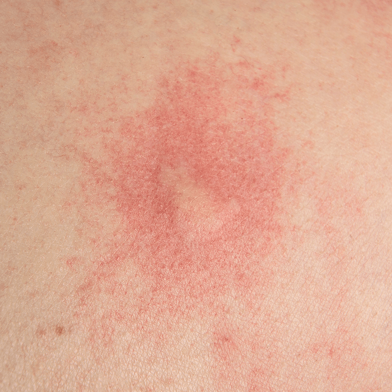 postive skin allergy prick test weal (1)