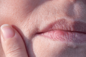 facial hair (hirsutism) caused by polycystic ovary syndrome - PCOS