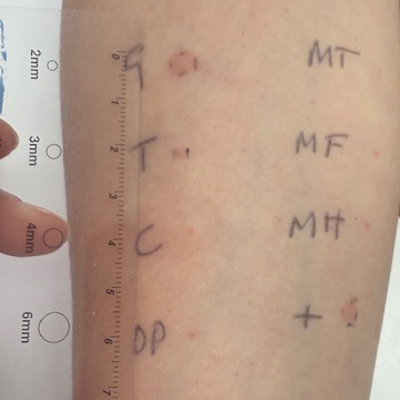 allergy skin prick test measuring weal