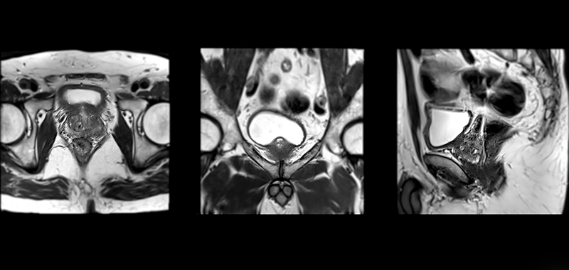 MRI prostate scan