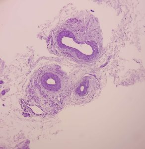 prostate cancer cells from a biopsy
